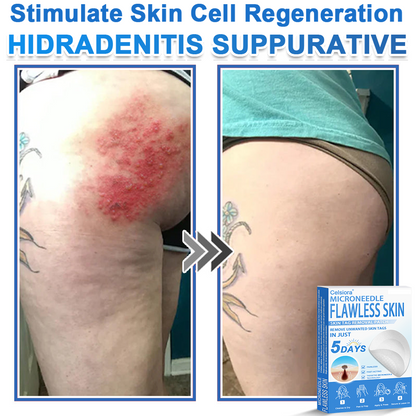 ✅Celsiora® 2-in-1 Microneedle & Hydrocolloid Patch | Raised Moles,Acne,  Flat Warts & Skin Tags Remover | Improves Wrinkles, Scars & Blemishes | Invisible Star Pimple Patches for Face & Body