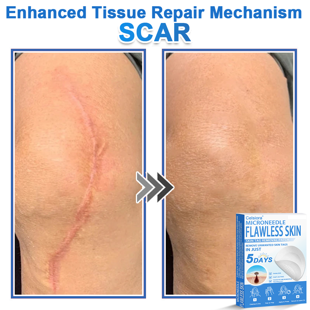 ✅Celsiora® 2-in-1 Microneedle & Hydrocolloid Patch | Raised Moles,Acne,  Flat Warts & Skin Tags Remover | Improves Wrinkles, Scars & Blemishes | Invisible Star Pimple Patches for Face & Body