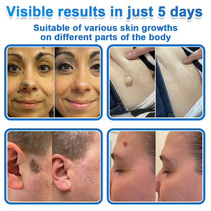 ☀️Celsiora® 2-in-1 Microneedle & Hydrocolloid Patch | Raised Moles,Acne,  Flat Warts & Skin Tags Remover | Improves Wrinkles, Scars & Blemishes | Invisible Star Pimple Patches for Face & Body