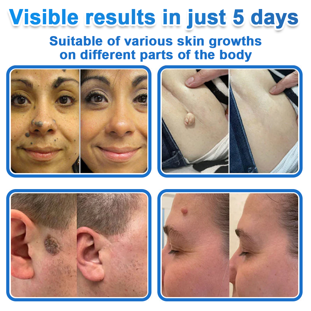 ⭐Celsiora® 2-in-1 Microneedle & Hydrocolloid Patch | Raised Moles,Acne,  Flat Warts & Skin Tags Remover | Improves Wrinkles, Scars & Blemishes | Invisible Star Pimple Patches for Face & Body