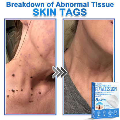🌙Celsiora® 2-in-1 Microneedle & Hydrocolloid Patch | Raised Moles,Acne,  Flat Warts & Skin Tags Remover | Improves Wrinkles, Scars & Blemishes | Invisible Star Pimple Patches for Face & Body