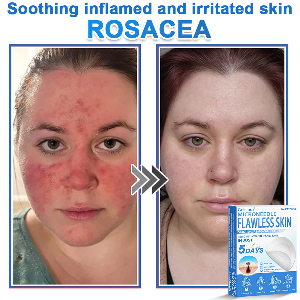 ⭐Celsiora® 2-in-1 Microneedle & Hydrocolloid Patch | Raised Moles,Acne,  Flat Warts & Skin Tags Remover | Improves Wrinkles, Scars & Blemishes | Invisible Star Pimple Patches for Face & Body
