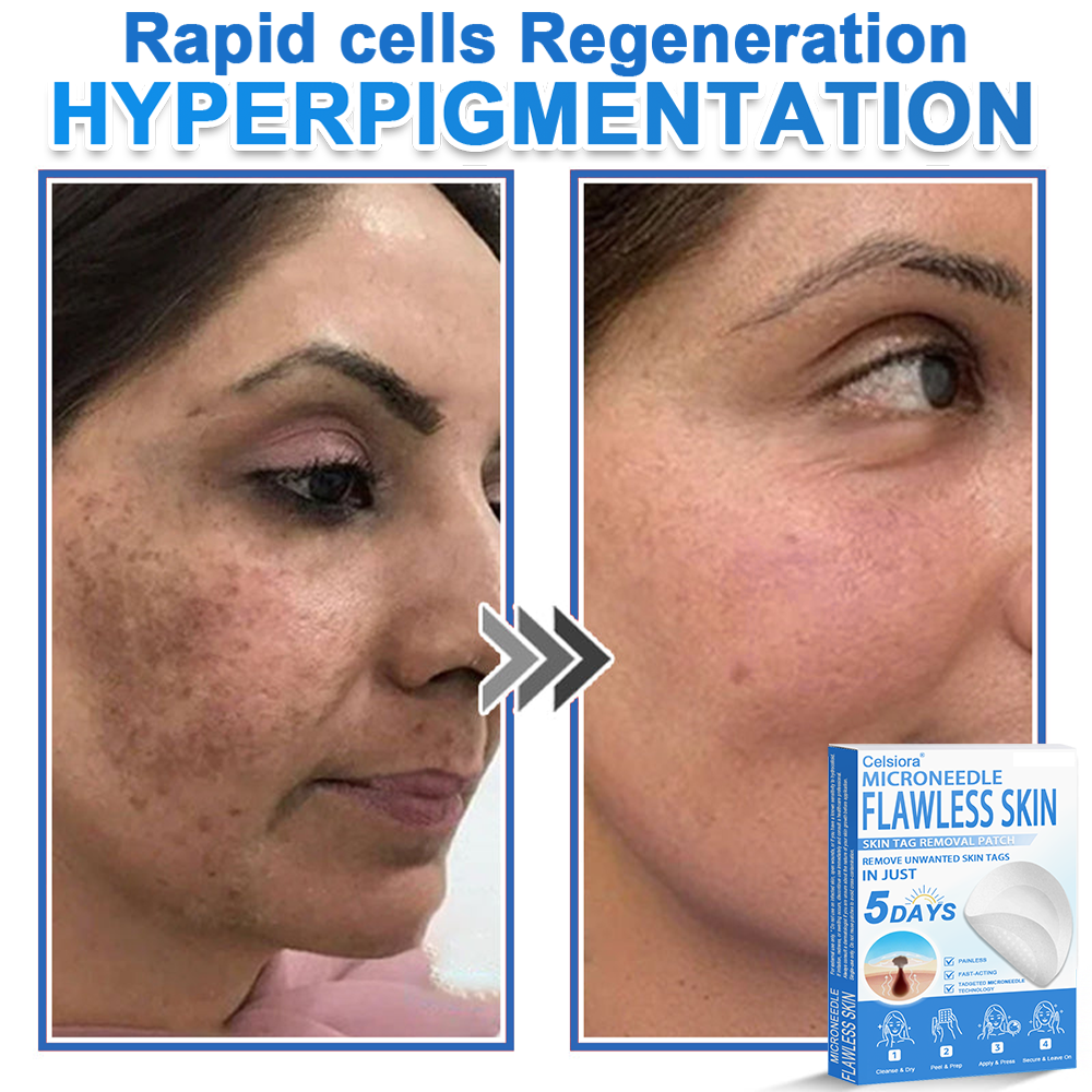 🌙Celsiora® 2-in-1 Microneedle & Hydrocolloid Patch | Raised Moles,Acne,  Flat Warts & Skin Tags Remover | Improves Wrinkles, Scars & Blemishes | Invisible Star Pimple Patches for Face & Body