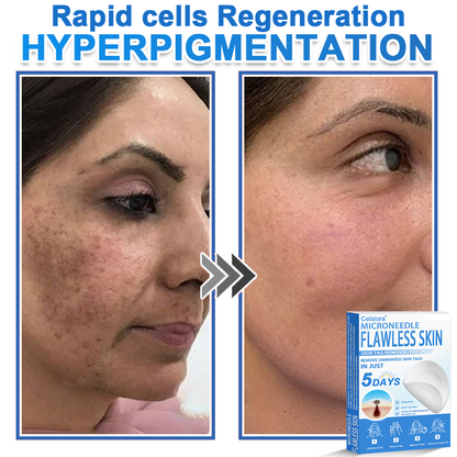 🌙Celsiora® 2-in-1 Microneedle & Hydrocolloid Patch | Raised Moles,Acne,  Flat Warts & Skin Tags Remover | Improves Wrinkles, Scars & Blemishes | Invisible Star Pimple Patches for Face & Body